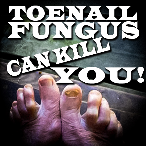 TOENAIL-FUNGUS-CAN-KILL-YOU